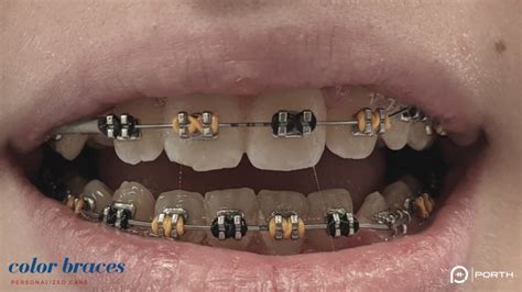 Neutral Braces Colors