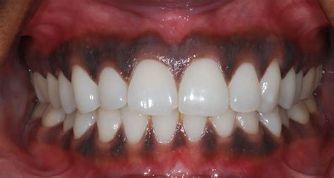 Black Gums