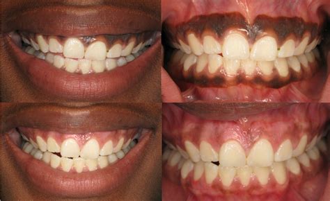 Gingival Depigmentation