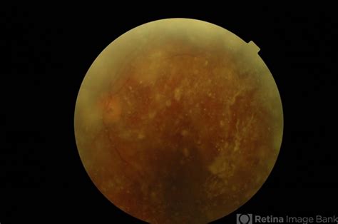 Retina